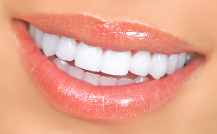 Veneers Lake Forest